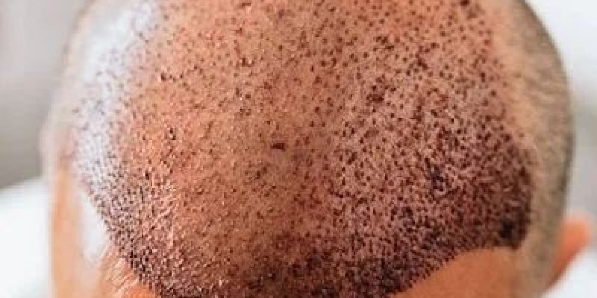 Why Tourists Are Choosing Hair Transplant in Dubai for Hair Restoration