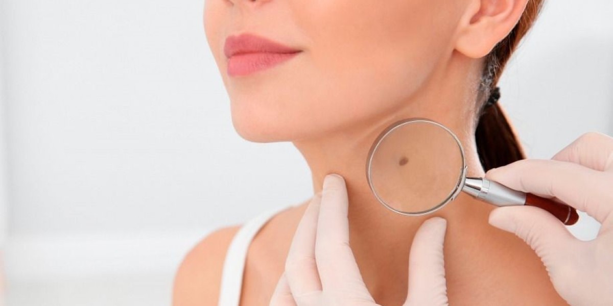 Mole Removal in Dubai: How Clinics Ensure Safety and Precision