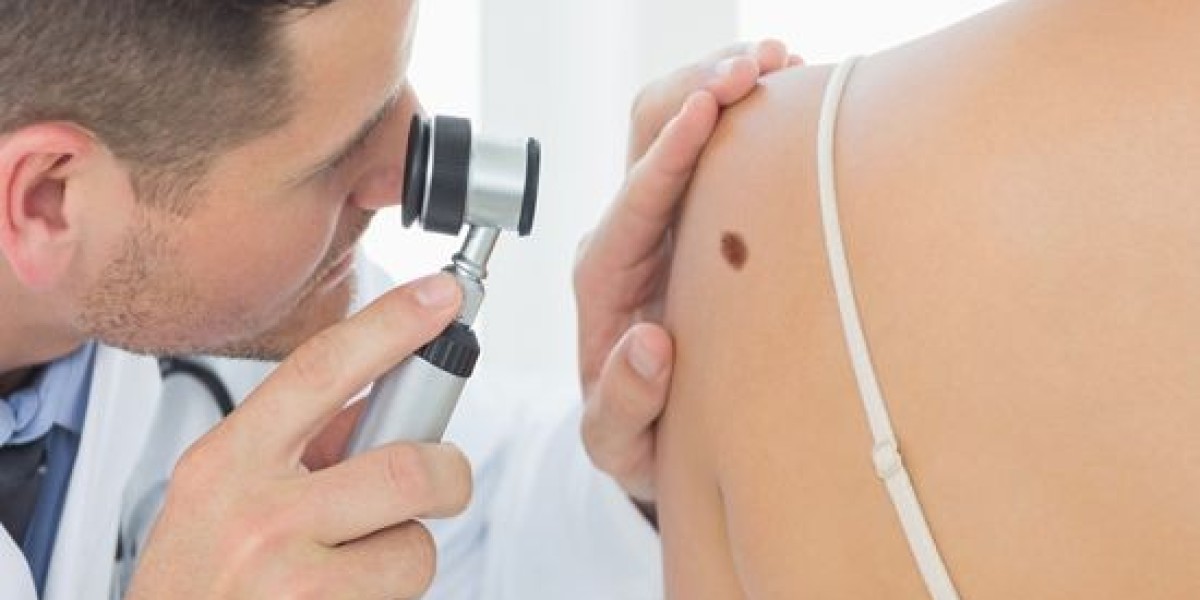 Mole Removal in Dubai: What Type of Mole Is Safe to Remove?
