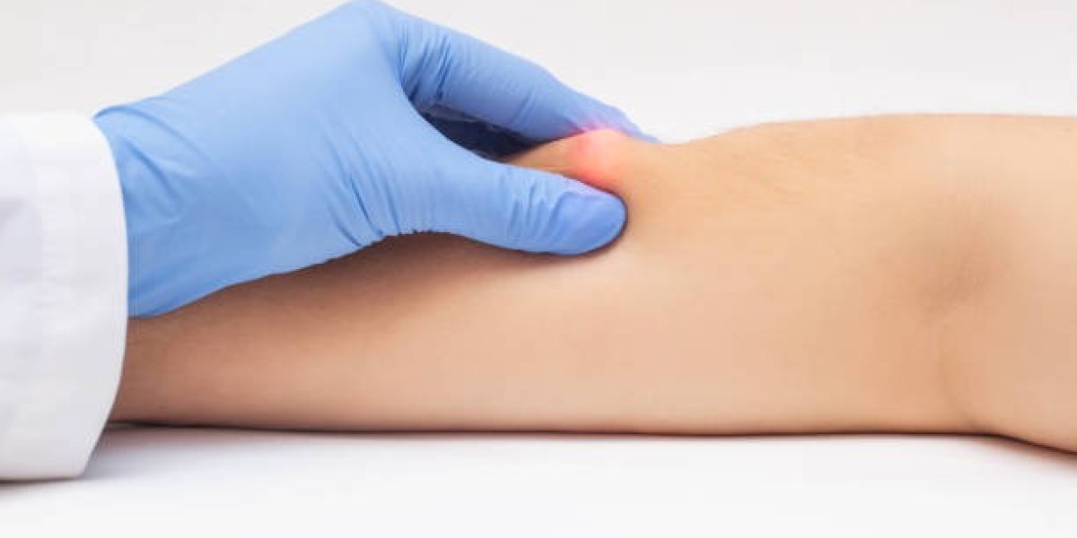 Affordable Lipoma Treatment in Dubai Without Surgery