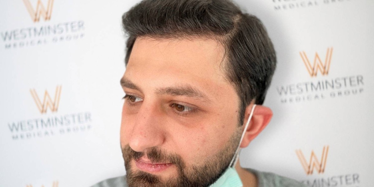Why Choosing a Hair Transplant in London Is the Smartest Decision for Lasting Hair Restoration