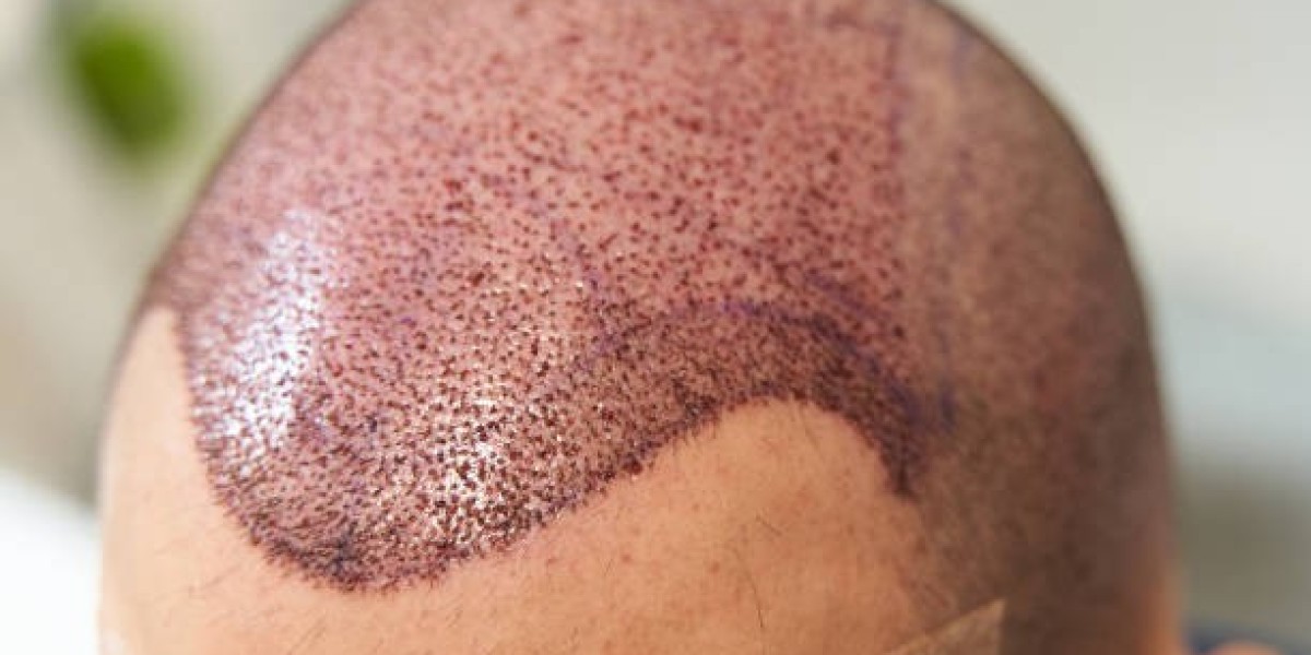 Hair Transplant in Riyadh: Real Results