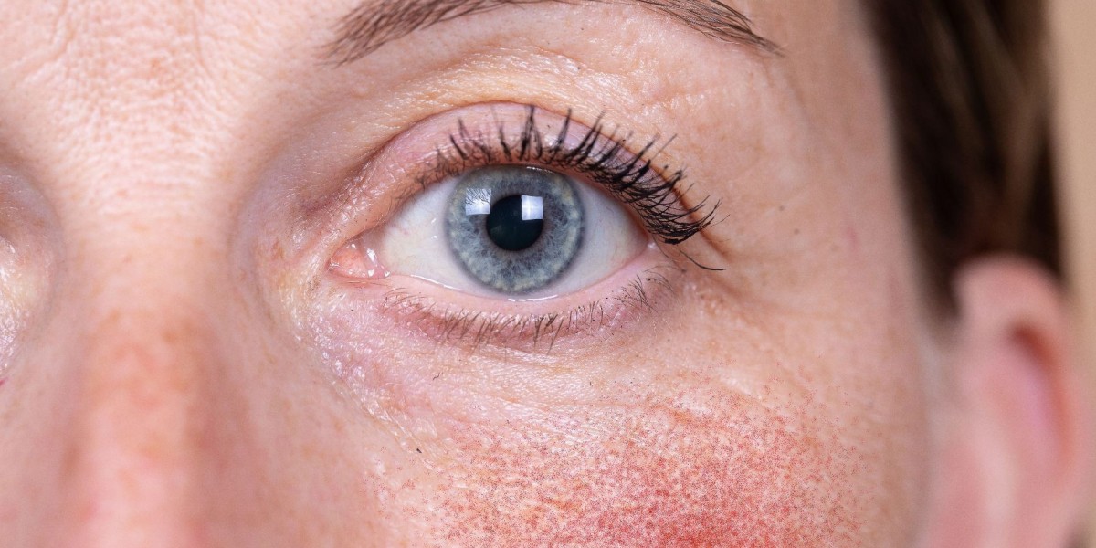 Is Port Wine Stain Treatment Safe for Infants?