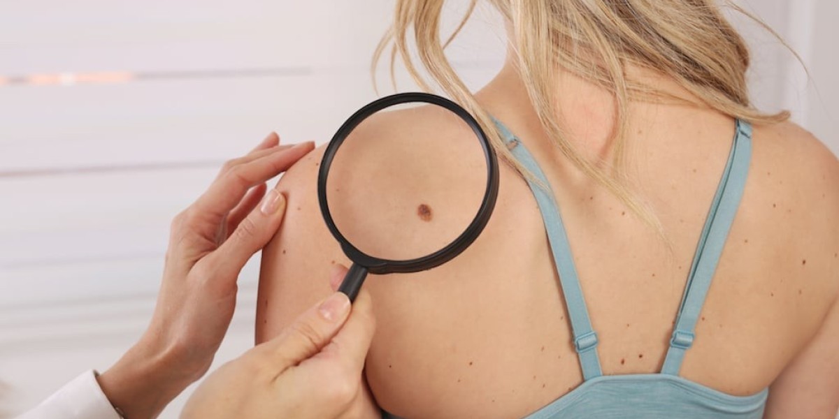 Does Birthmark Removal Improve Skin Appearance?
