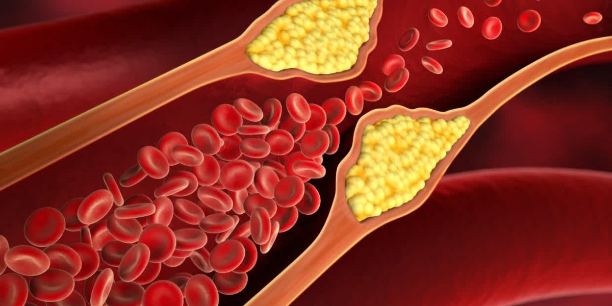 Managing High Cholesterolemia Dubai Through Diet and Exercise