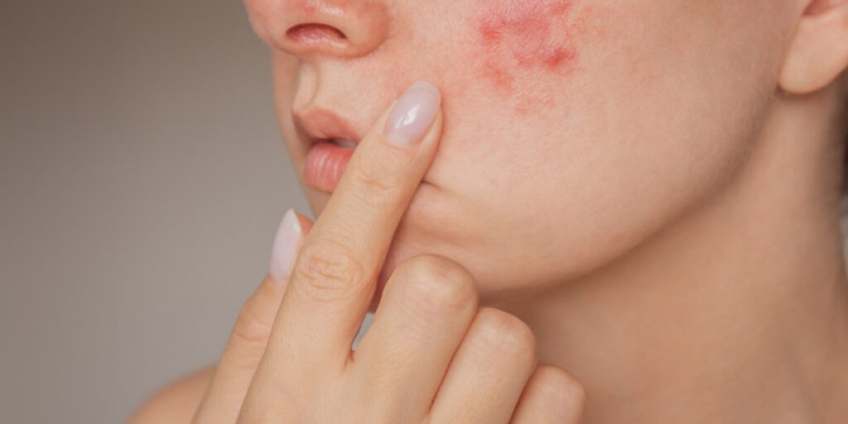 Enjoy Youthful Radiance Daily Using Acne Treatment Dubai