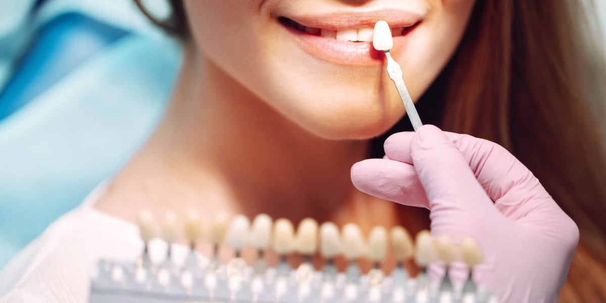 Dental Veneers Cost That Turn Your Smile into a Stunning Masterpiece