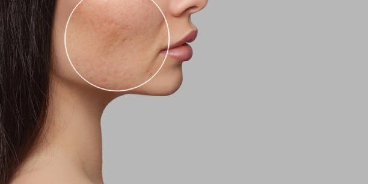 Laser Acne Treatment: Boost Confidence Today