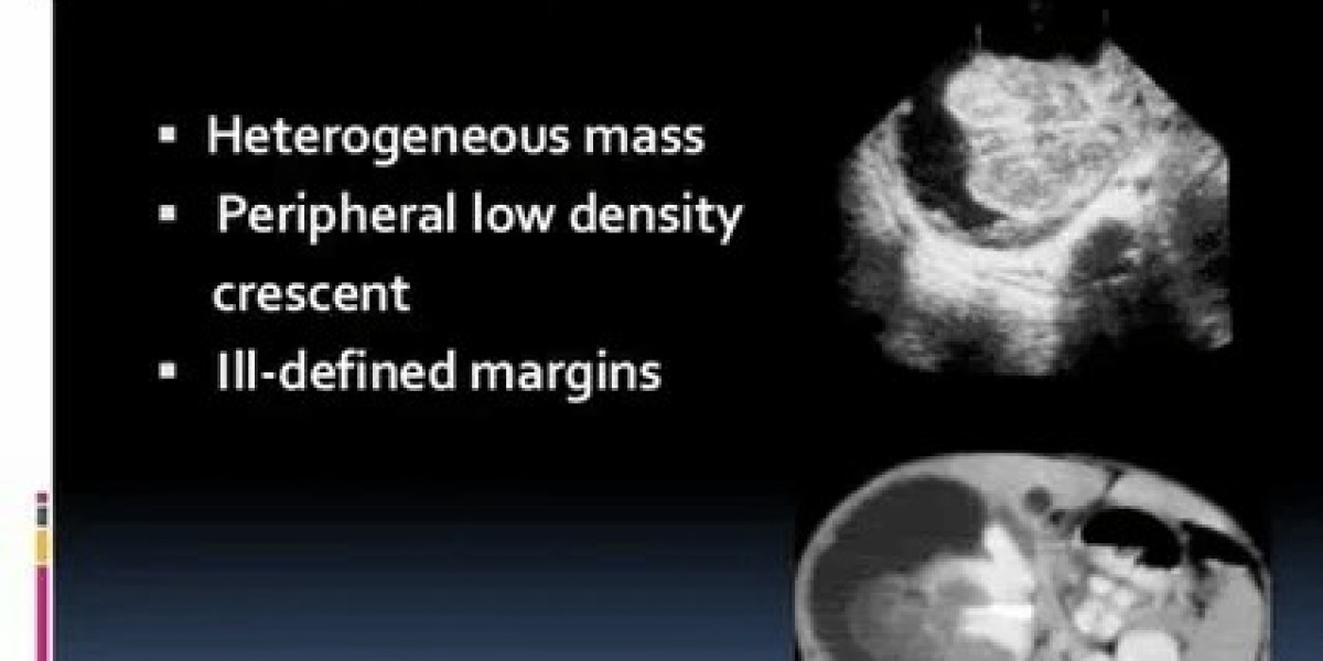 Rhabdoid Tumor Therapeutics Market Pipeline Overview