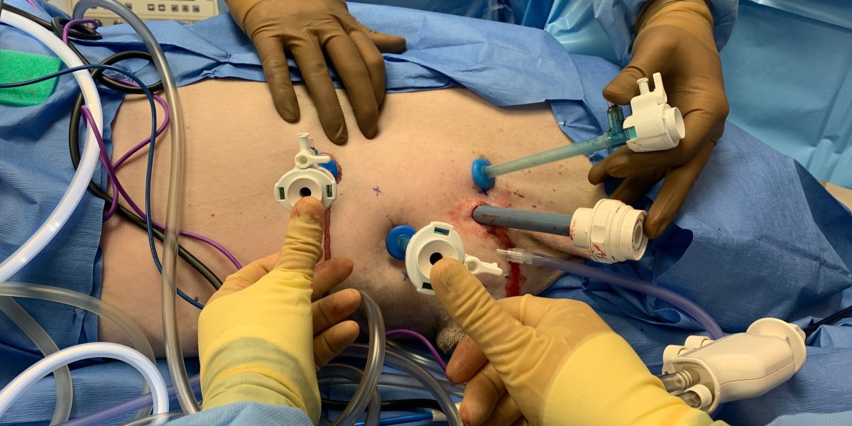 Can Laparoscopic Surgery Be An Effective Tool For Weight Loss?