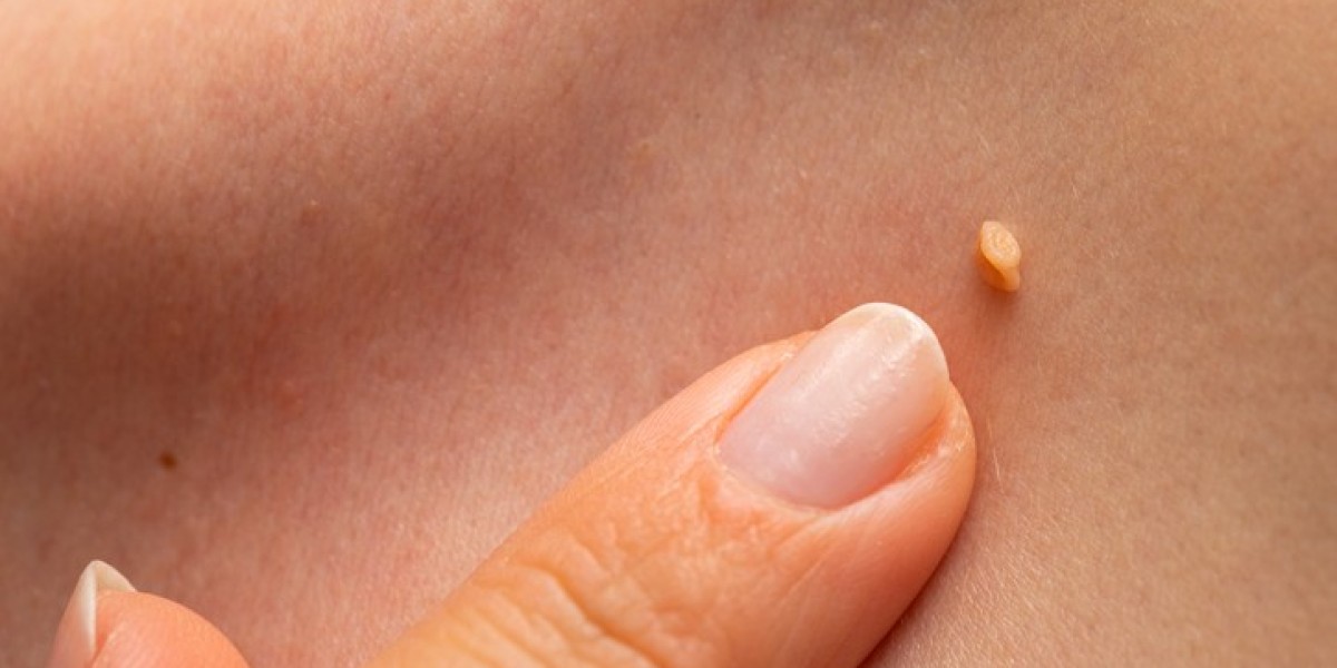 Wart Removal for Sensitive Areas: What You Need to Know