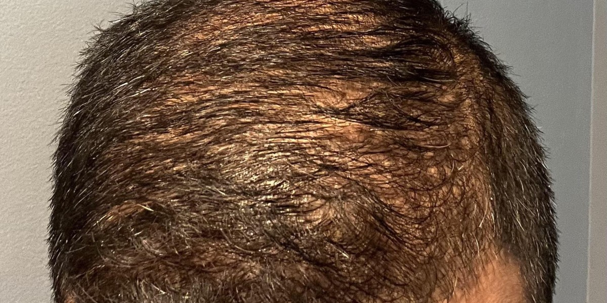 How Does A Crown Hair Transplant Address Specific Hair Loss?