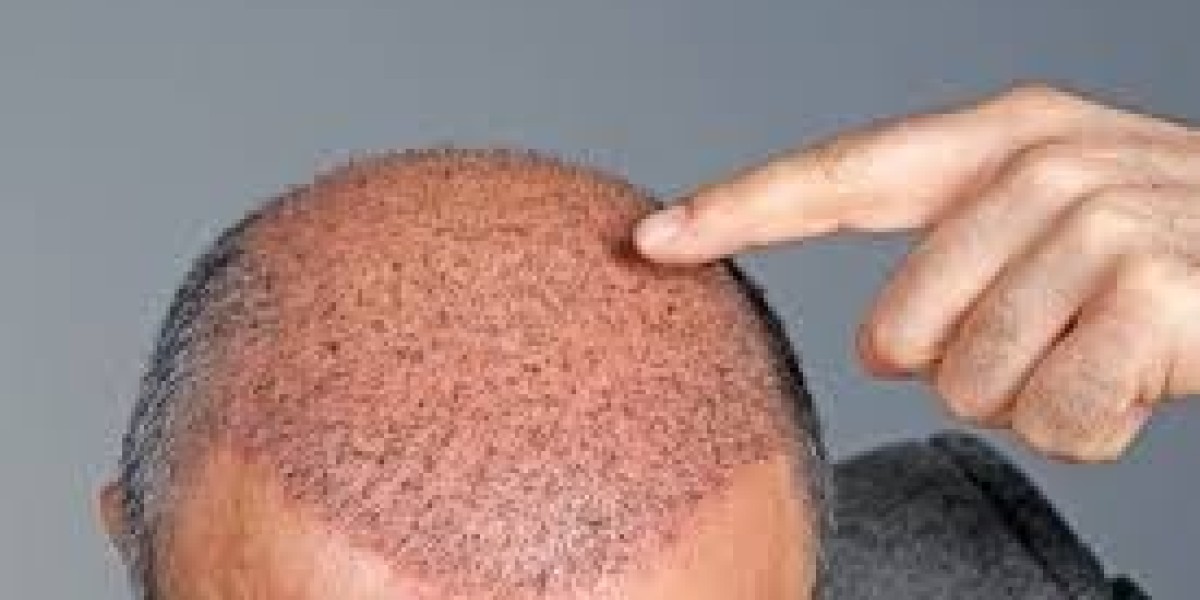 How Do FUE and FUT Hair Transplant Techniques Differ?