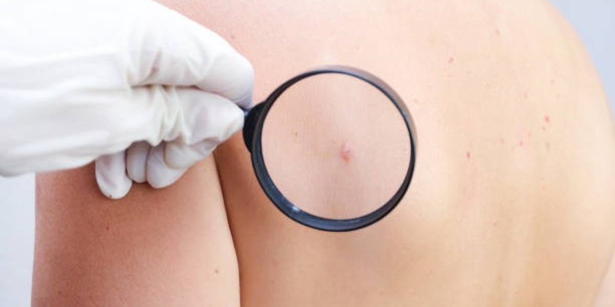 Post-Removal Skin Care for Healthy Healing