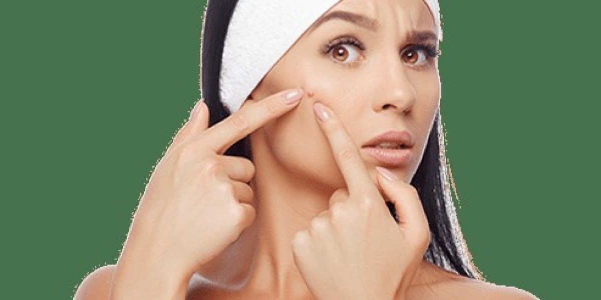 Shine Confidently Naturally with Acne Treatment Dubai Approaches
