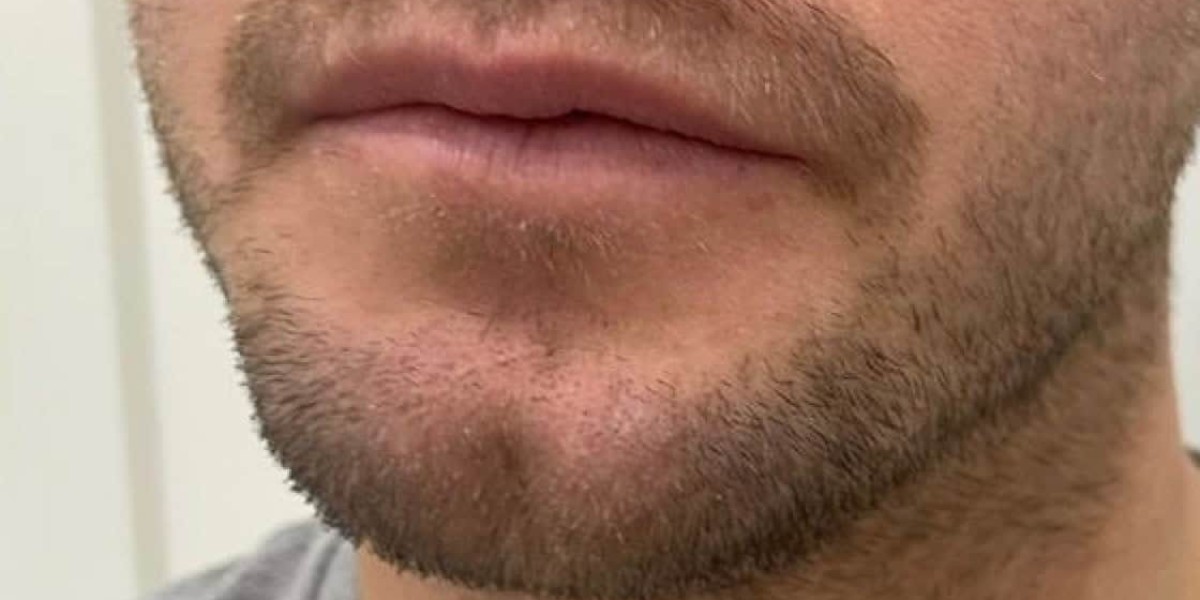 Do Chin Dimples Change Shape as You Age?