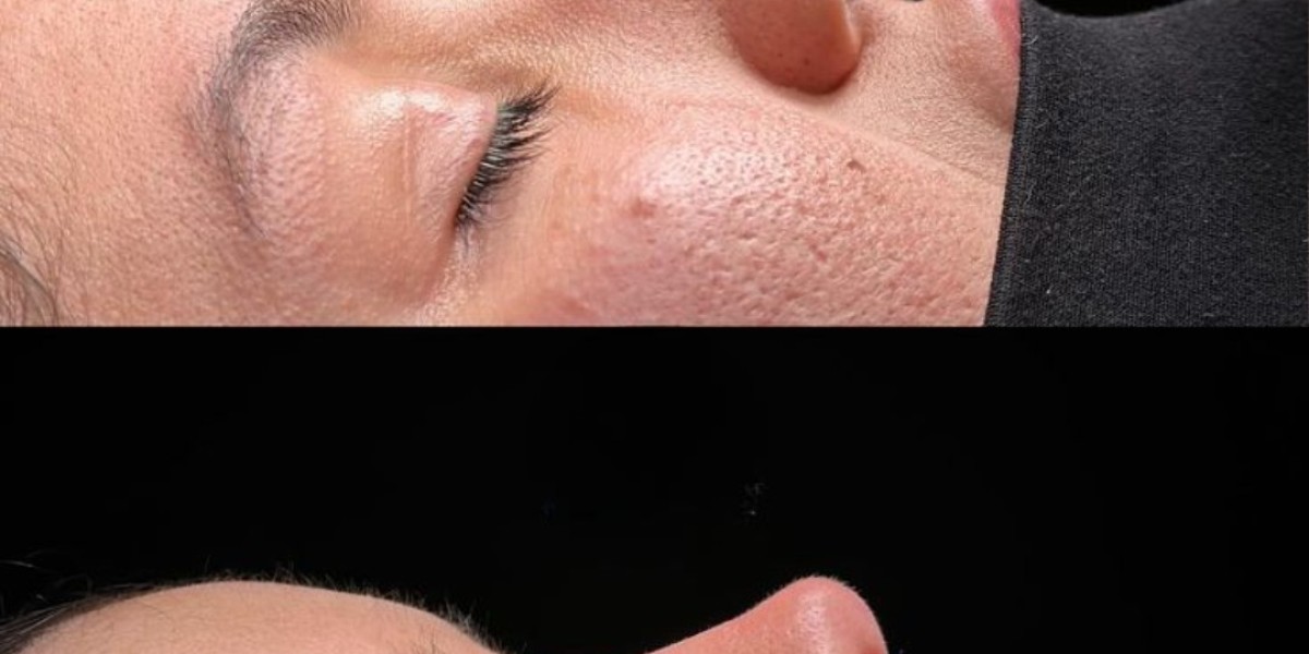 Transform Your Look with Rhinoplasty in Islamabad