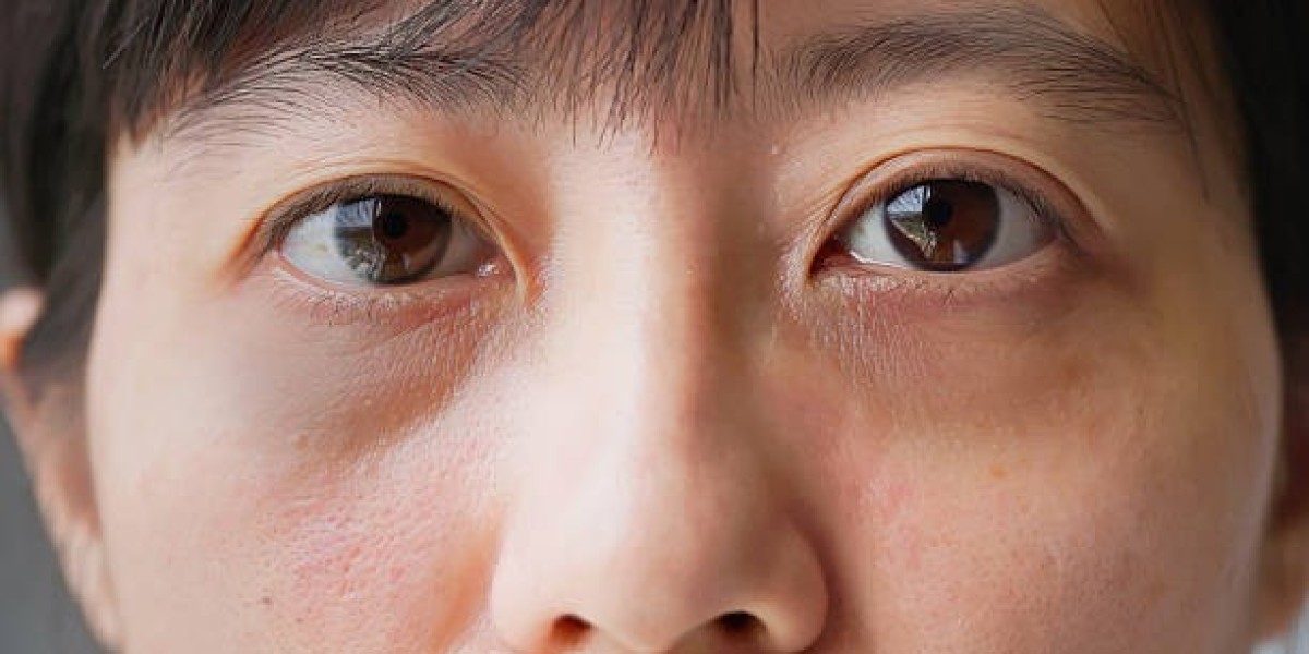 Eye Bag Removal in Dubai: What You Need to Know