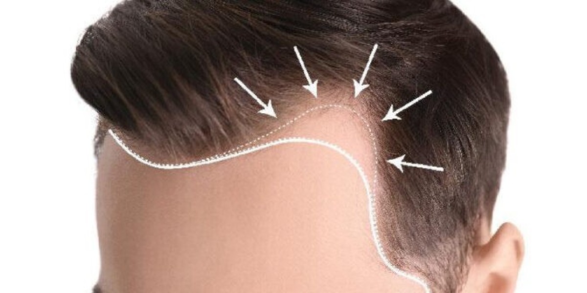 Can FUT Hair Transplant Improve Hairline Shape?