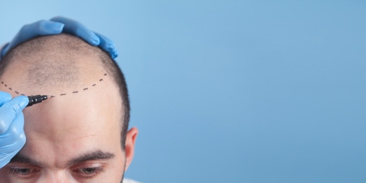 Comparing Hair Transplant Cost in Gurgaon: What Patients Should Expect