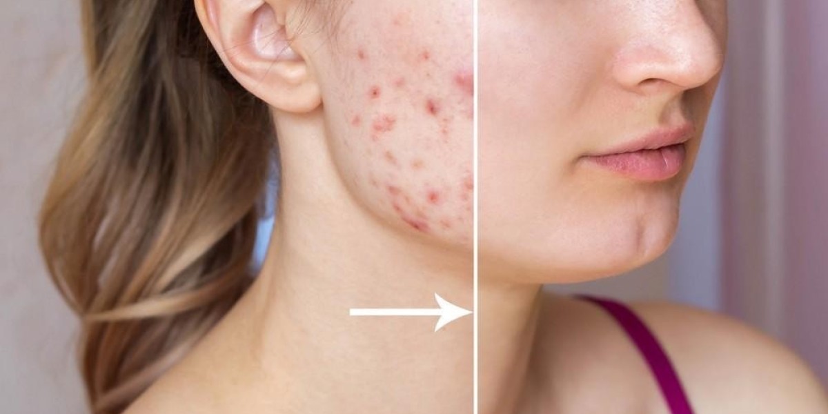 Top Dermatologists for Acne Removal Dubai