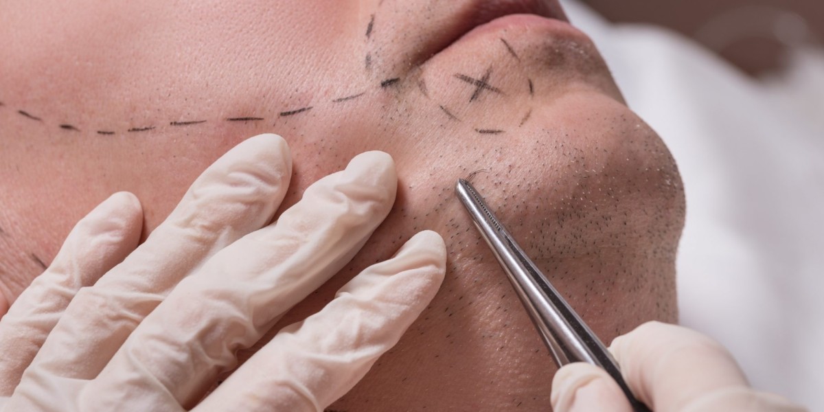 How Well Can a Beard Transplant in Dubai Treat Patchy Beard Growth?