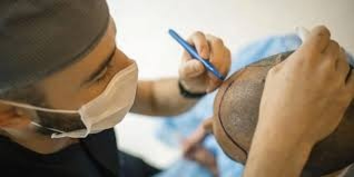 What Are the Top Hair Restoration Clinics in My Area?