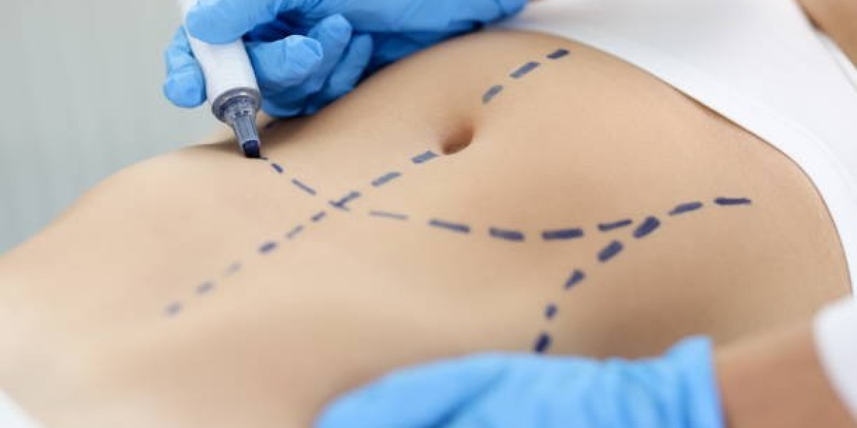 Mini Tummy Tuck in Dubai: Fast Results, Minimal Downtime