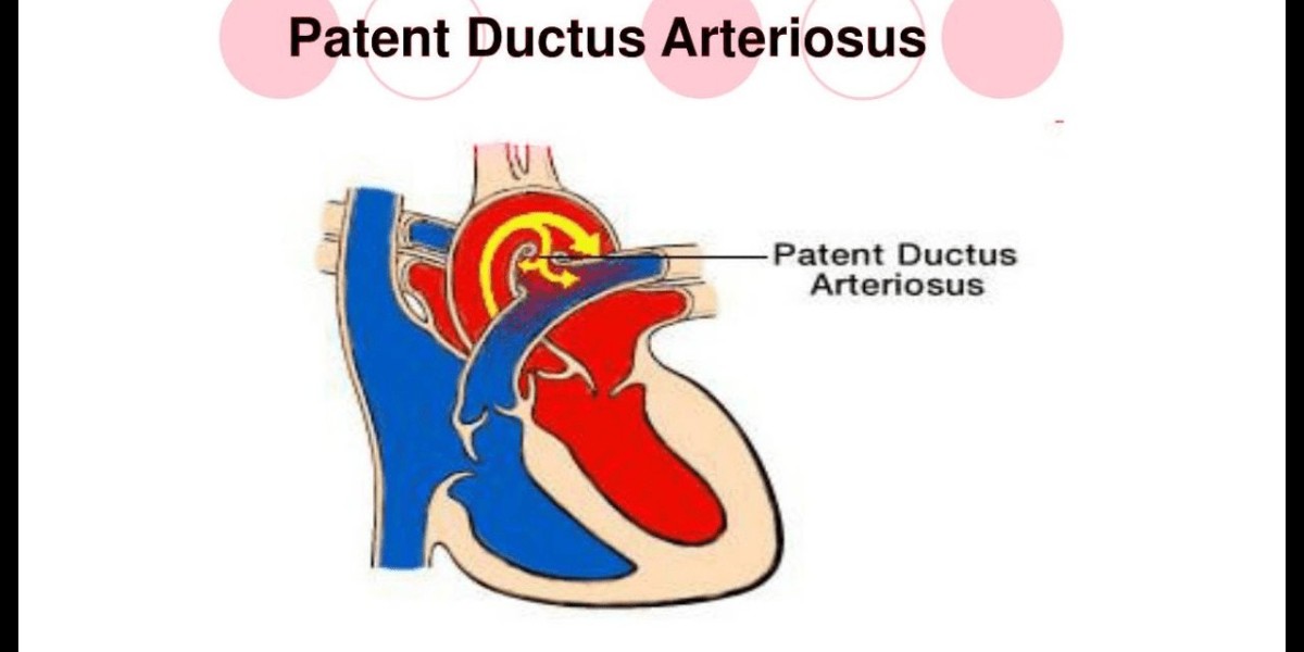 Patent Ductus Arteriosus Treatment Market Therapeutic Trends