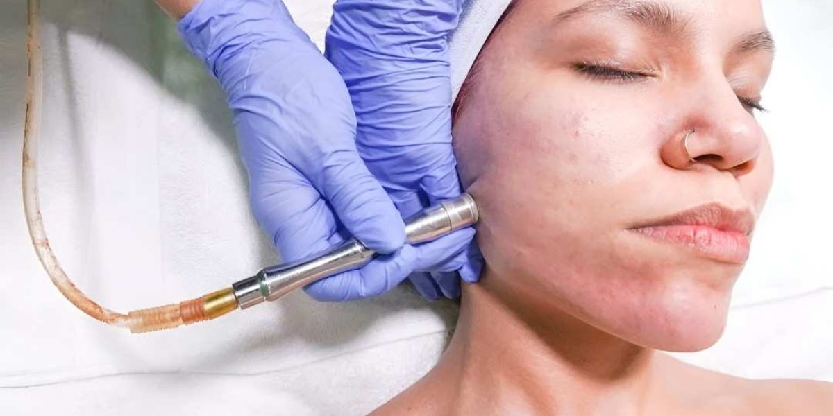 Microdermabrasion in Islamabad for Flawless Glow