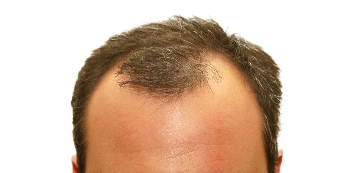Finasteride 1mg Price Guide for Beginners