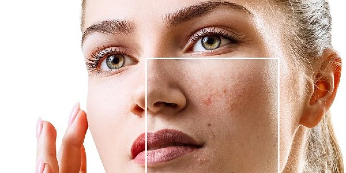 Dubai Acne Scar Treatment: Non-Surgical Laser Options