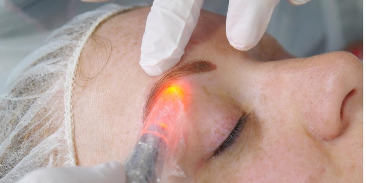 Want pigmentation fade using an Erbium Peel?