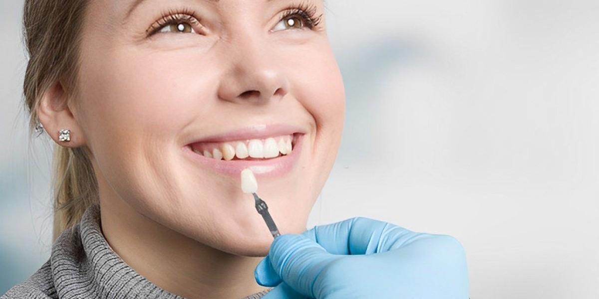 Why People Ask About Composite Veneers in Dubai
