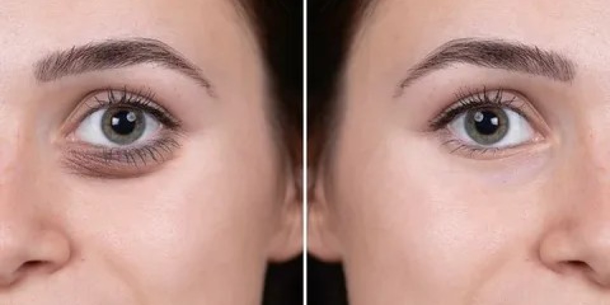 Fillers in Dubai: Enhance Your Facial Features Safely