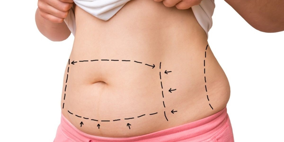 Can a Tummy Tuck Effectively Remove Lower Belly Fat?