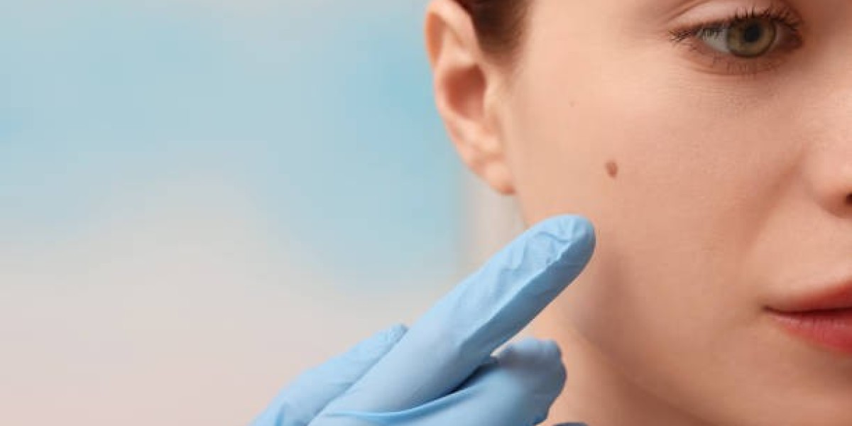 Mole Removal Benefits for Long-Term Skin Wellness