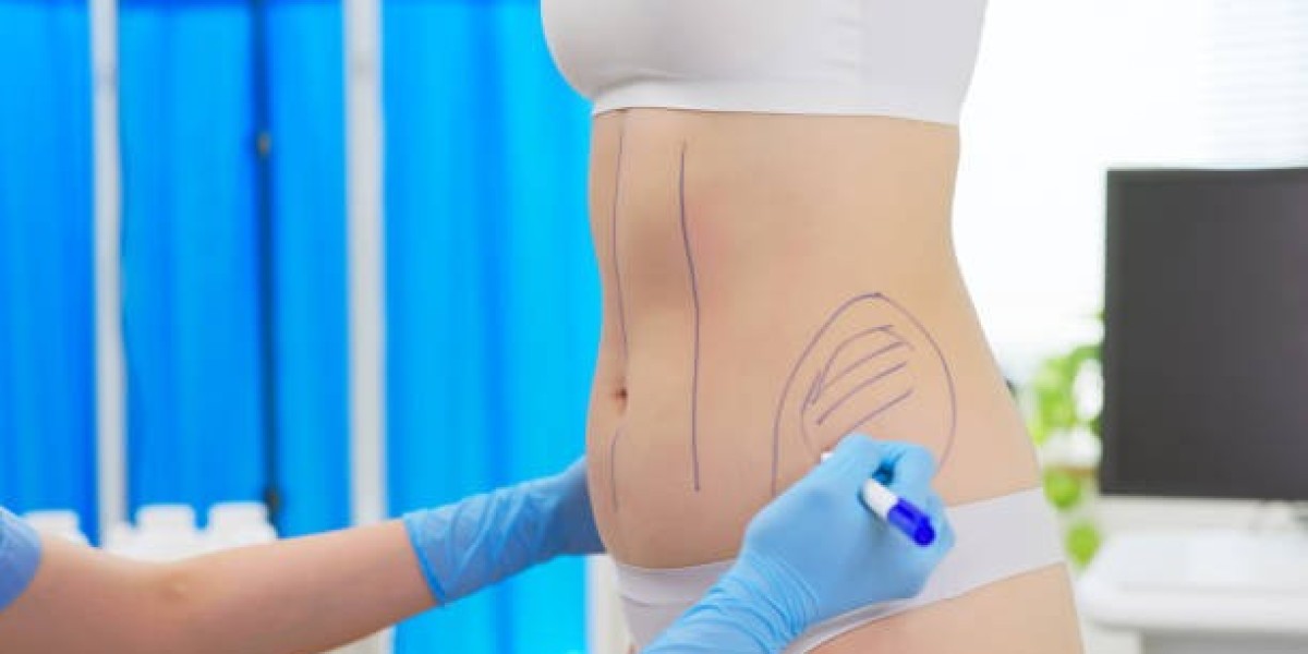 Refine Your Body Contours: Ultimate Guide to Liposuction in Islamabad