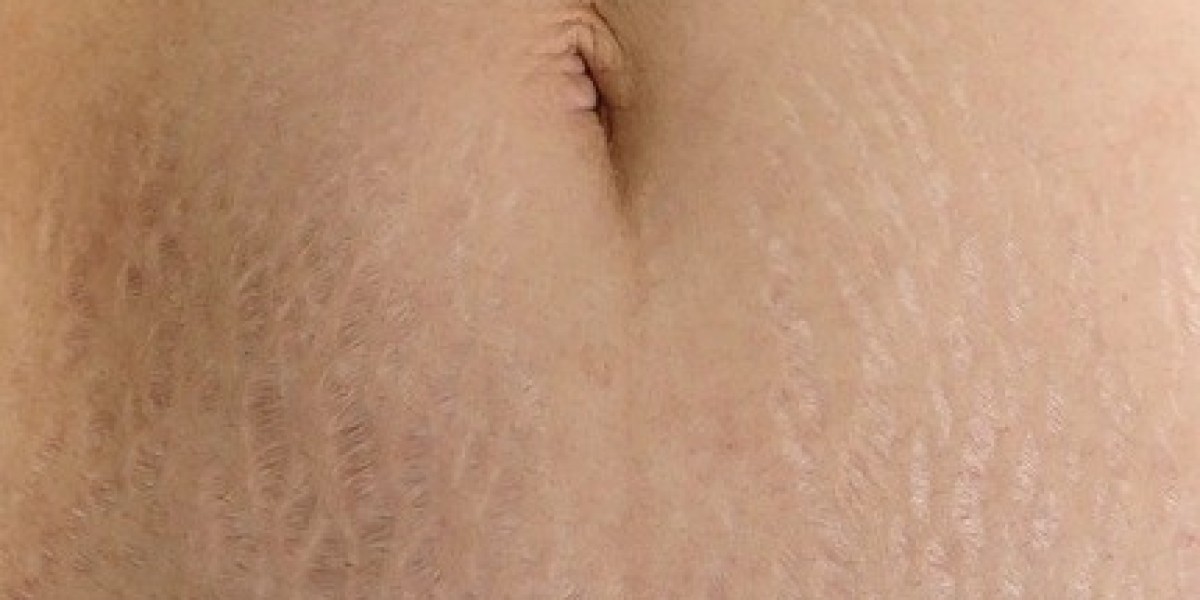 Discover the Most Effective Stretch Marks Treatment for Smoother Skin