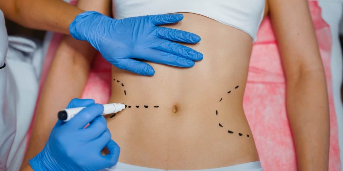 Liposuction Recovery Week by Week: A Realistic Timeline