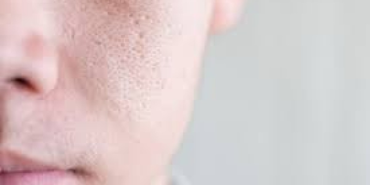 Do Men and Women Experience Large Pores Differently?