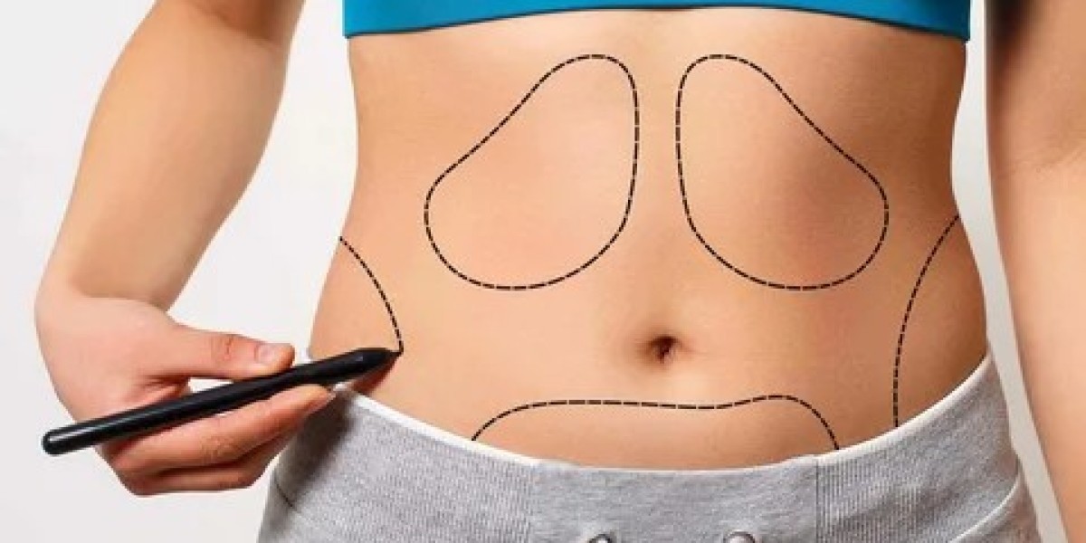 Liposuction in Islamabad by Experienced Surgeons