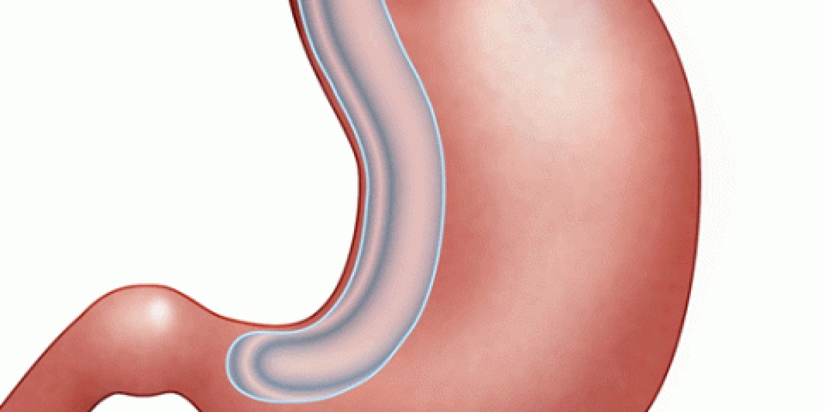 What Are The Major Advantages Of Opting For Gastric Sleeve Surgery?