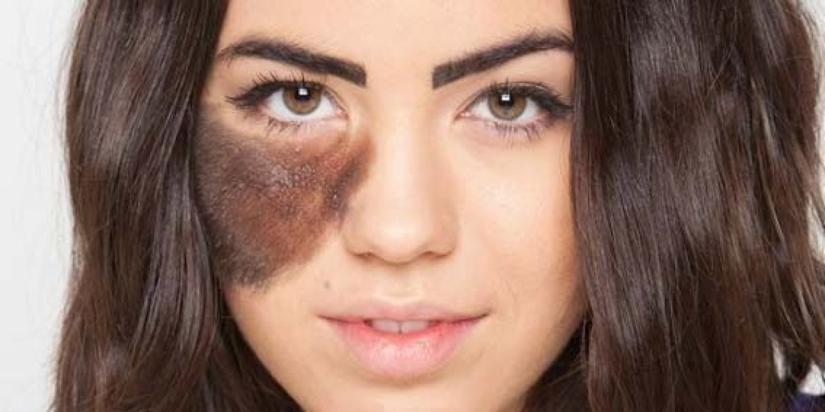 How Birthmark Removal in Dubai Can Transform Your Skin