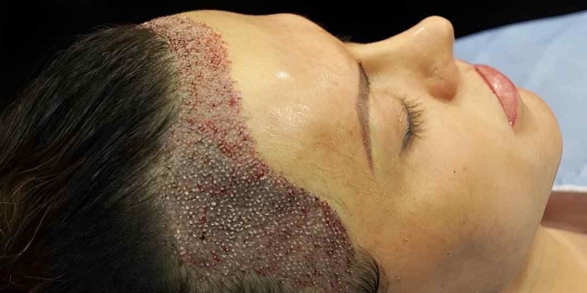 FUE Hair Transplant in Islamabad: How Long Do Results Last?