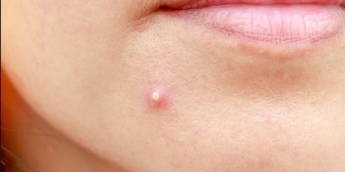 Best Pimples Treatment for Blackheads?