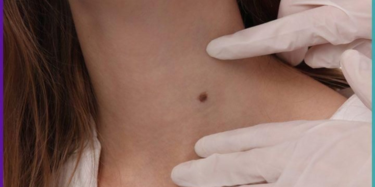 Mole Removal in Dubai: Removing Body Moles Safely and Effectively