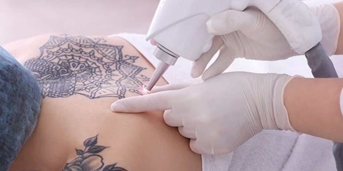 Is Laser Tattoo Removal Effective for Dark Ink Tattoos?