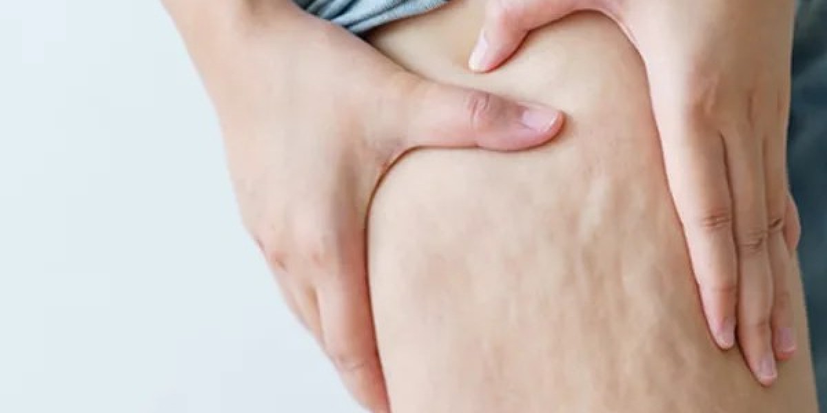 Can Cellulite Be Completely and Permanently Removed?