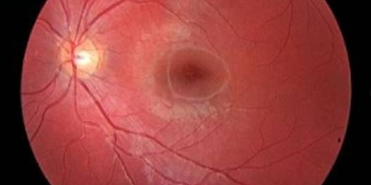 Future of Retinal Disease Care: Global Retinal Dystrophy Treatment Market Overview